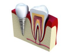 affordable dental implants in Truckee California