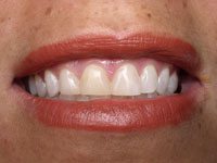 Brinn before teeth whitening in Truckee CA