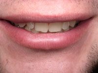 Evan before restorative dentistry in Truckee CA