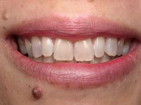 Gabraele before cosmetic dentistry in Truckee CA