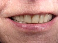 Pauline before getting cosmetic dentistry