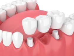 Replacing missing teeth Dr. Donald Reid