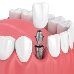dental implant, single implant, replace missing tooth, implant dentistry