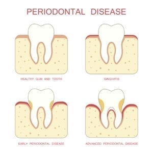 periodontal therapy in Truckee California