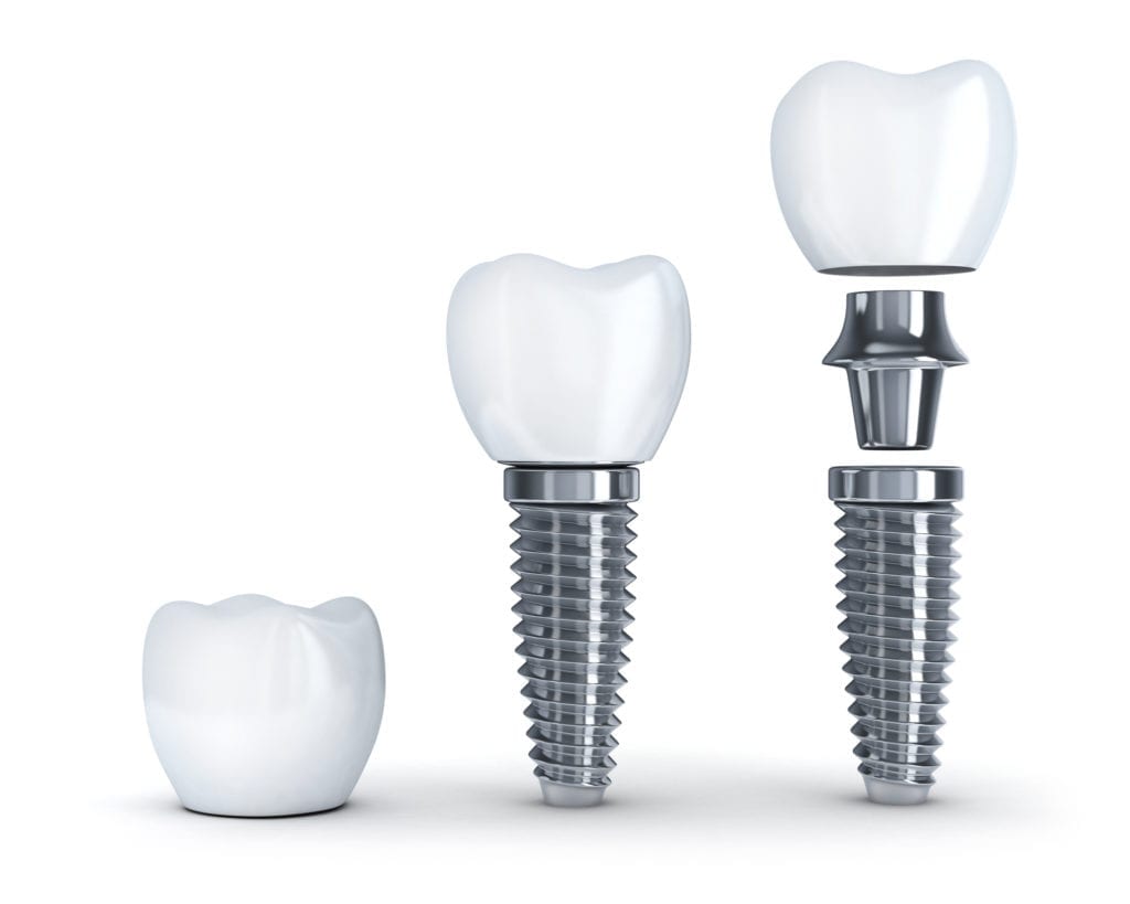 dental implants reno nv
