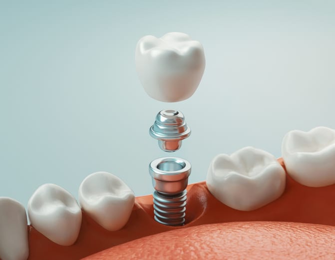 Dental Implants Truckee, CA