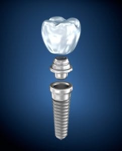 Dental Implants Truckee, California