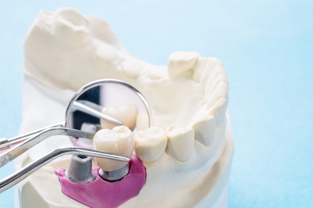 Dentures and Implants in Truckee, California