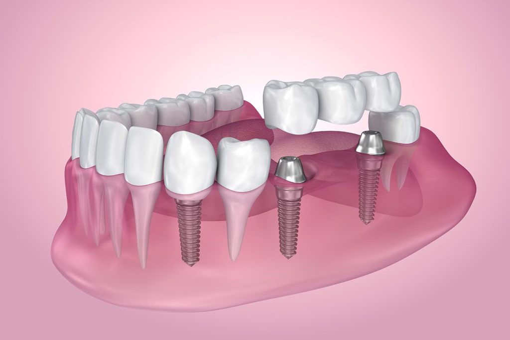 Dr. Jason Baldwin offers multiple dental implants in Truckee and Loyalton CA