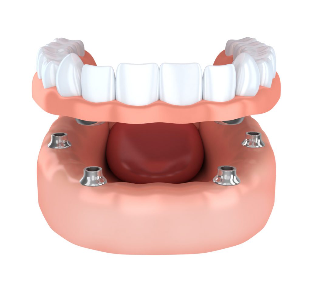 Denture Implants Truckee CA