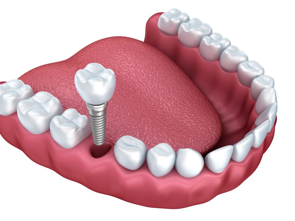 Learn more about a Single Dental Implant in Truckee, CA and Loyalton, CA