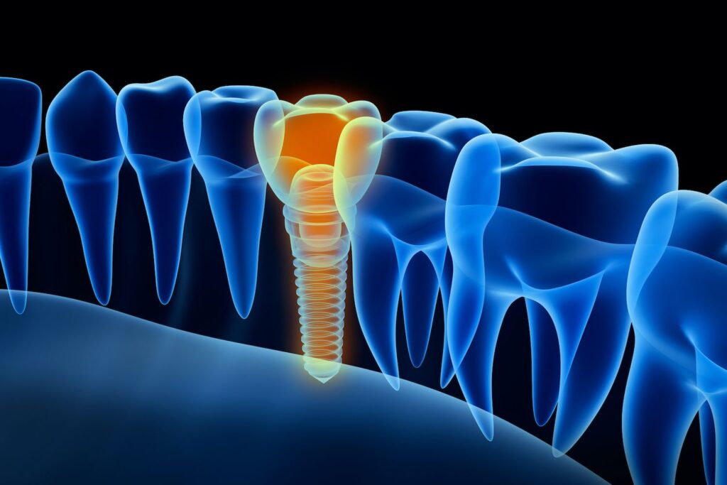 Dental Implants vs. Dentures