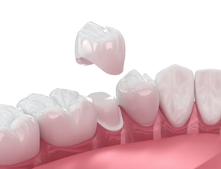 A Look at the CEREC Same-Day Process in Truckee, CA